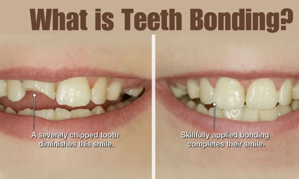 What is Teeth Bonding