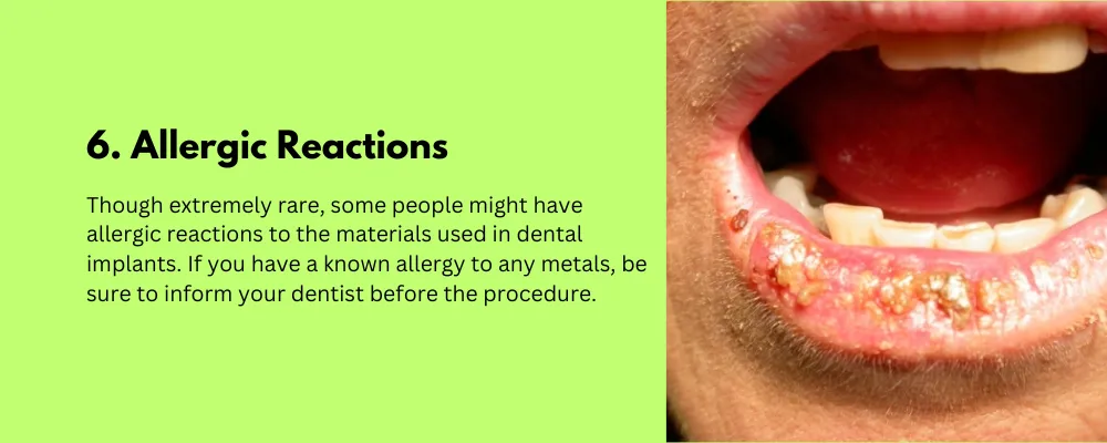Allergic Reactions-Side Effect of Dental Implant