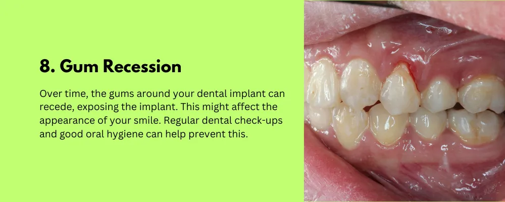 Gum Recession-Side Effect of Dental Implant