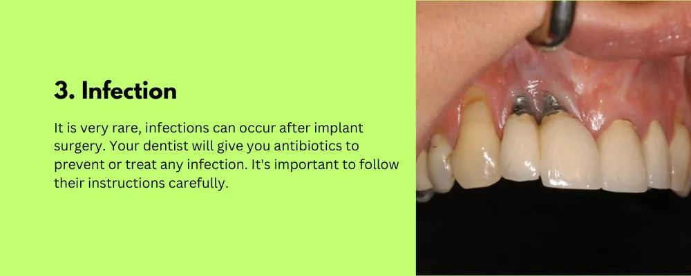 Infection-Side Effect of Dental Implant