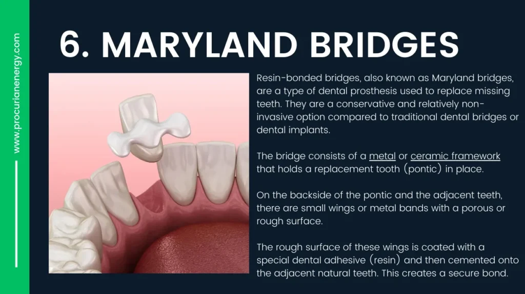 Resin-Bonded Bridges (Maryland Bridges)-Alternative to Dental Implants