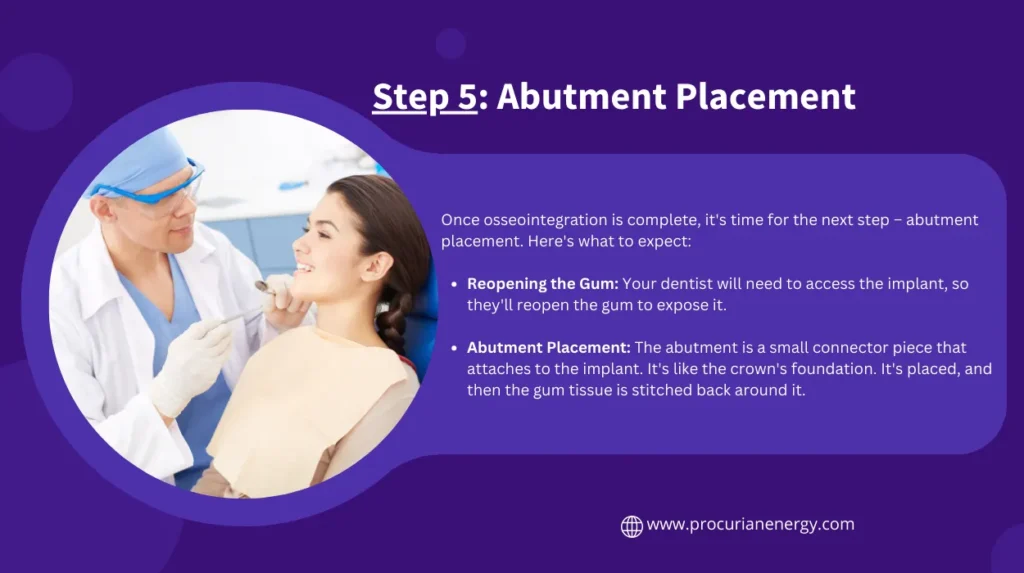 Step 5: Abutment Placement