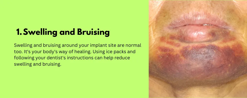 Swelling and Bruising-Side Effect of Dental Implant